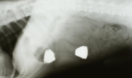 Xray of foreign body - stones